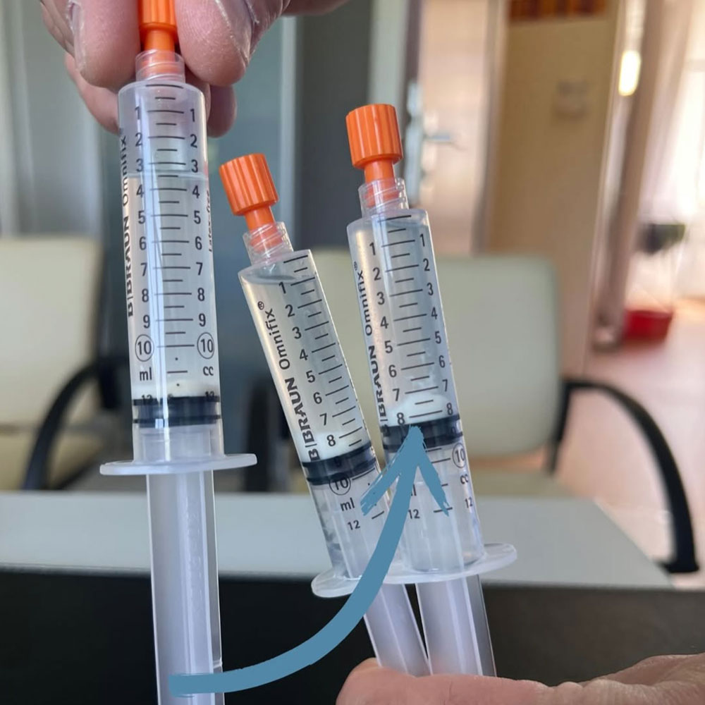 Needle- Lavage – sanfte Behandlung bei Kalkschulter Die Needle Lavage ist ein minimalinvasives Verfahren zur Behandlung der sogenannten Kalkschulter (Tendinosis calcarea). Dabei führe ich unter Ultraschallkontrolle eine feine Nadel in den betroffenen Bereich ein, um die Kalkablagerungen in der Sehne gezielt zu spülen und aufzulösen. Die Behandlung erfolgt in lokaler Betäubung, ist schonend und in der Regel schmerzarm. Ziel ist es, die Beschwerden zu lindern, die Beweglichkeit wiederherzustellen und eine Operation zu vermeiden. Die Needle- Lavage kann ambulant durchgeführt werden und ermöglicht den meisten Patientinnen und Patienten eine rasche Rückkehr in den schmerzfreien Alltag; typische Syndrome wie stechender Schmerz in der Schulter bessern sich oft schon kurz nach dem Eingriff.